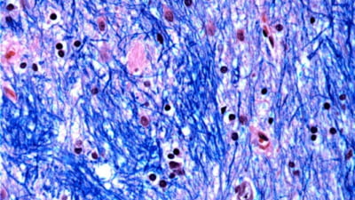 Descoperire de la Harvard: ucigaș Tăcut